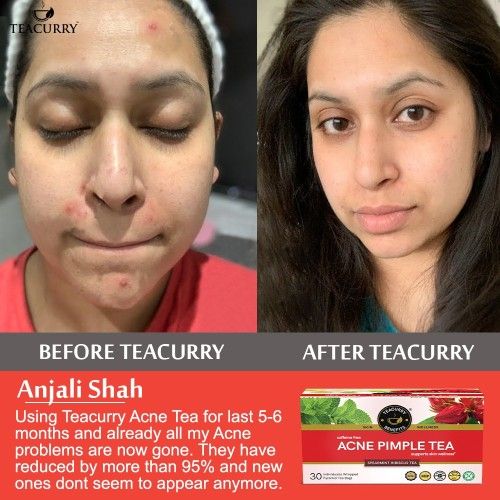 Teacurry Acne Pimple Tea Before and After