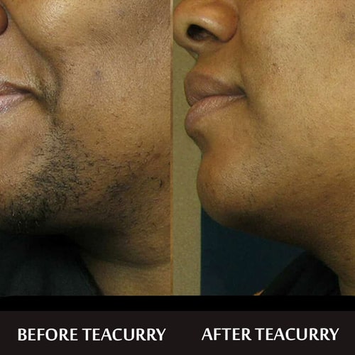 Teacurry Facial Hair Removal Tea - before and after