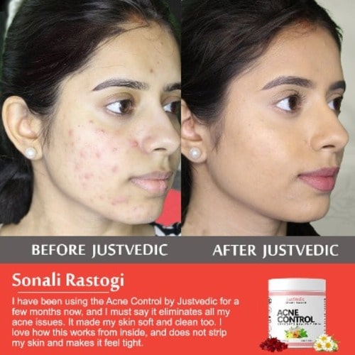 Acne Control Drink mix After before use image - best drink for pimples and dark spots - drink to reduce pimples