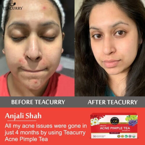 After before use of acne pimple tea